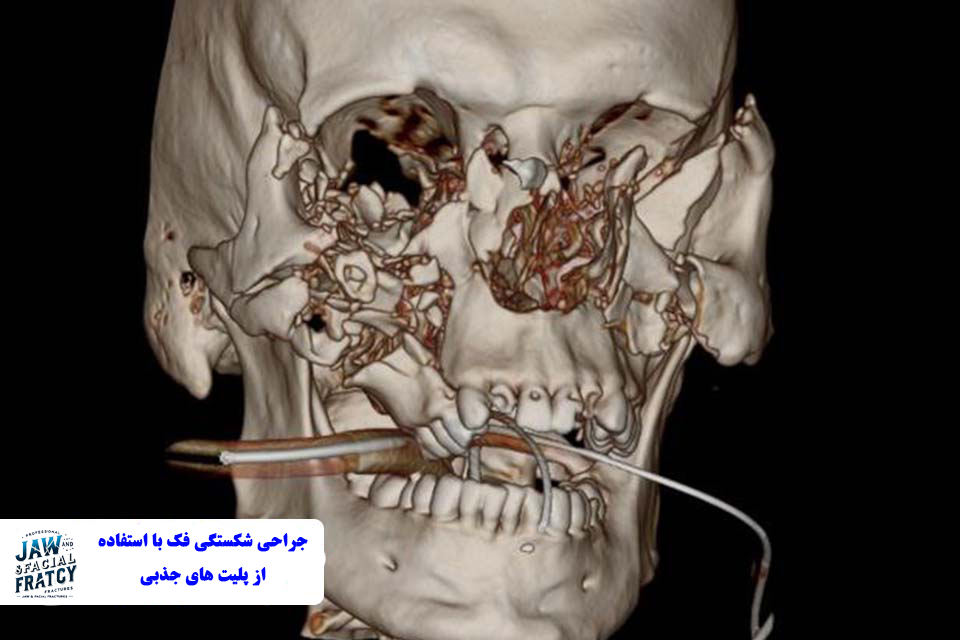 جراحی شکستگی فک با استفاده از پلیت های جذبی