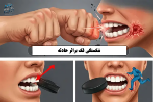 شکستگی فک