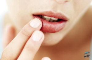 بی حسی لب بعد از شکستگی فک