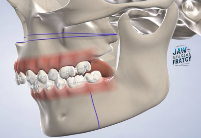 هزینه جراحی شکستگی فک
