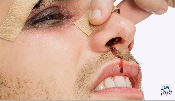 تفاوت شکستگی بینی و ضرب دیدگی بینی
