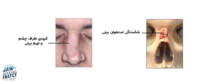 شکستگی استخوان بینی