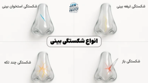 انواع شکستگی بینی
