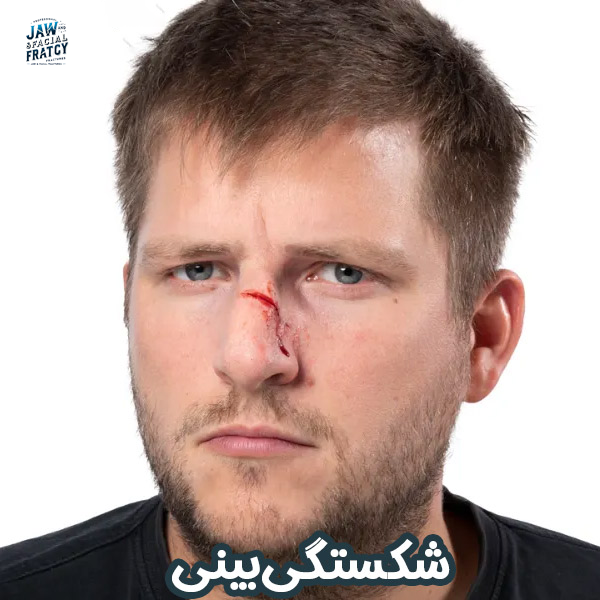 علائم شکستگی بینی