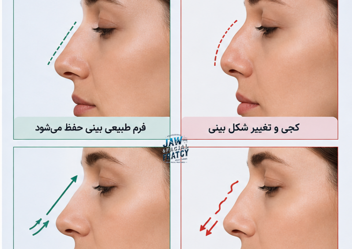وارض دیر درمان کردن بینی شکسته