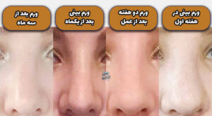 مدت زمان ورم بینی