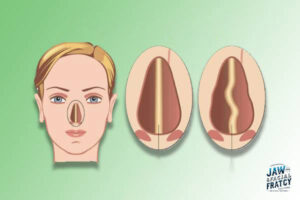 مراقبت بعد از جااندازی بینی