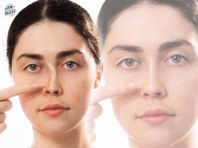 مراقبت‌های بعد از جا انداختن بینی
