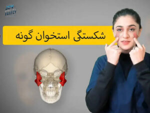 علائم شکستگی گونه