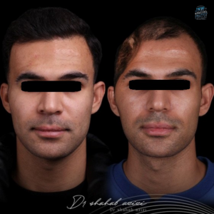 جراحی بازسازی پیشانی