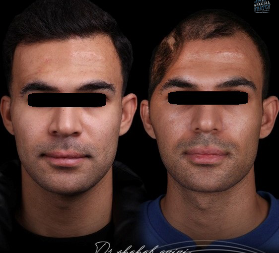 جراحی بازسازی پیشانی