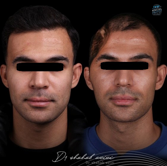 جراحی بازسازی پیشانی