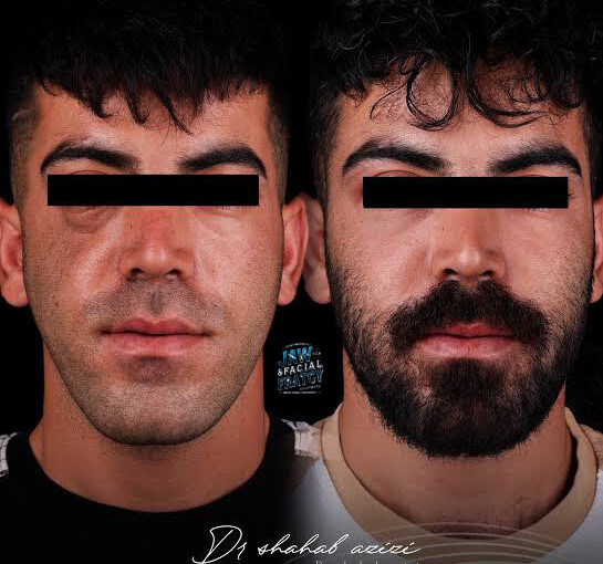 شکستگی گونه چیست