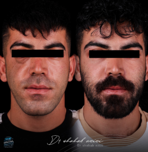 بهبود جای زخم شکستگی صورت